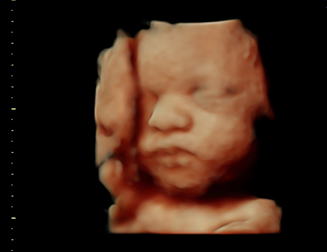 3D ultrasound image at 31 weeks